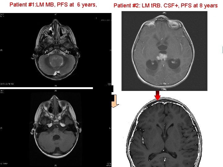 Patient #1: LM MB, PFS at 6 years, Patient #2: LM t. RB. CSF+,