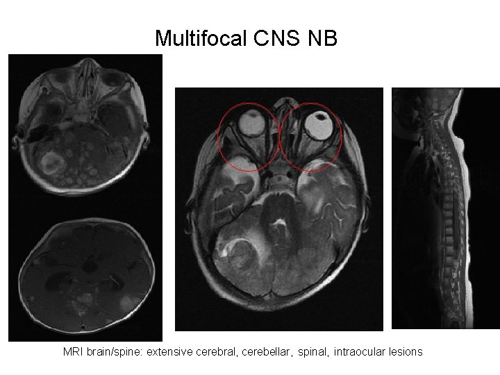Multifocal CNS NB MRI brain/spine: extensive cerebral, cerebellar, spinal, intraocular lesions 