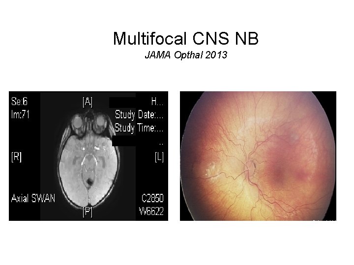 Multifocal CNS NB JAMA Opthal 2013 