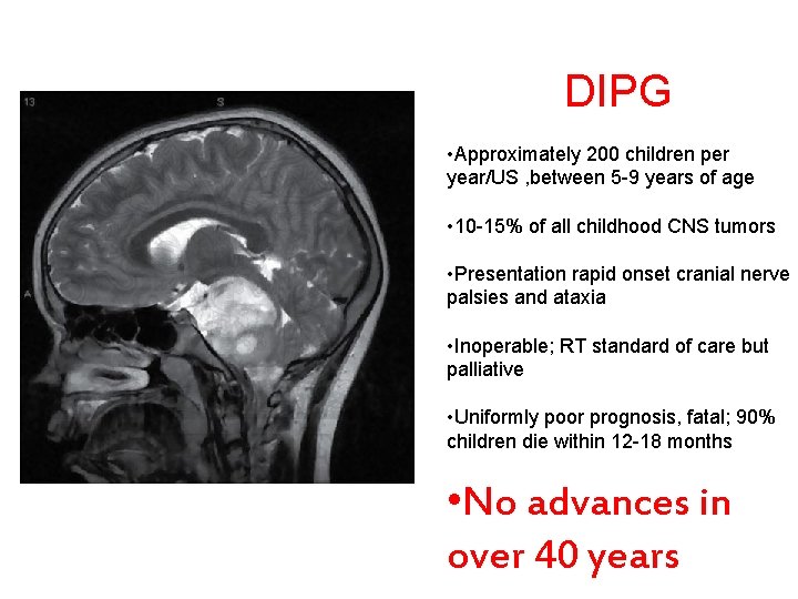 DIPG • Approximately 200 children per year/US , between 5 -9 years of age