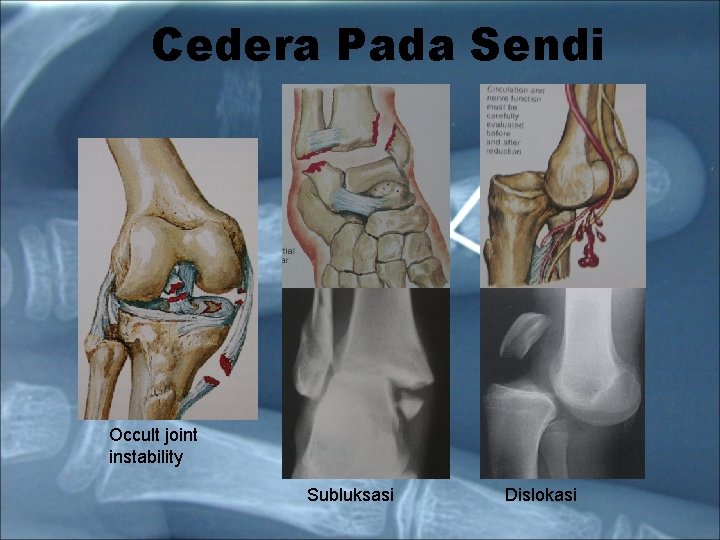 Cedera Pada Sendi Occult joint instability Subluksasi Dislokasi 