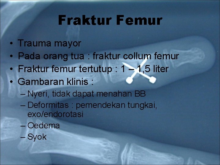 Fraktur Femur • • Trauma mayor Pada orang tua : fraktur collum femur Fraktur