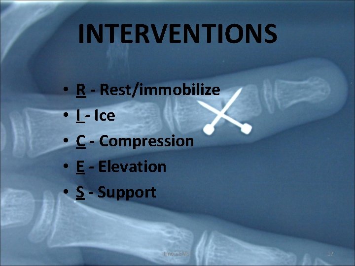 INTERVENTIONS • • • R - Rest/immobilize I - Ice C - Compression E