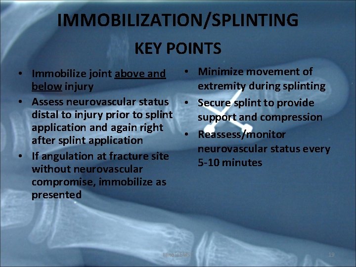 IMMOBILIZATION/SPLINTING KEY POINTS • Minimize movement of • Immobilize joint above and extremity during