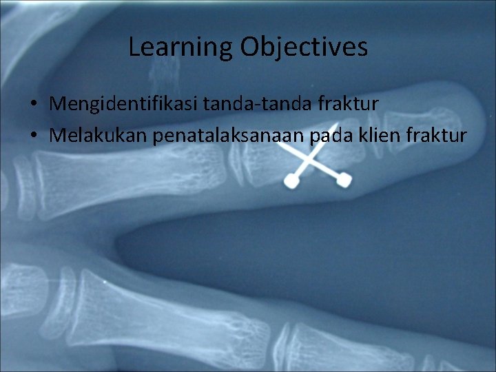 Learning Objectives • Mengidentifikasi tanda-tanda fraktur • Melakukan penatalaksanaan pada klien fraktur 