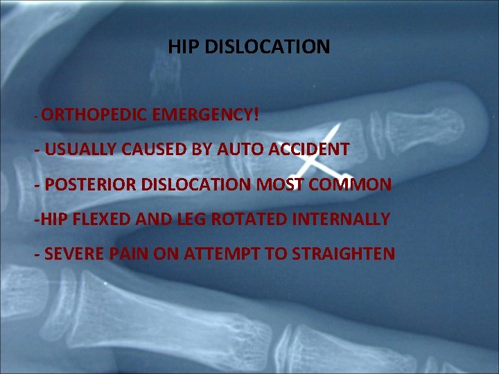 HIP DISLOCATION - ORTHOPEDIC EMERGENCY! - USUALLY CAUSED BY AUTO ACCIDENT - POSTERIOR DISLOCATION