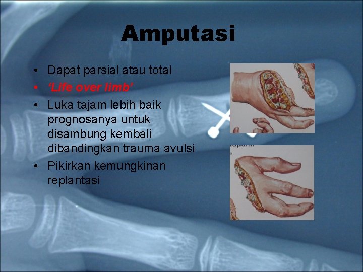 Amputasi • Dapat parsial atau total • ‘Life over limb’ • Luka tajam lebih