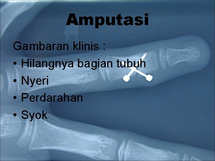 Amputasi Gambaran klinis : • Hilangnya bagian tubuh • Nyeri • Perdarahan • Syok Amputasi Gambaran klinis : • Hilangnya bagian tubuh • Nyeri • Perdarahan • Syok