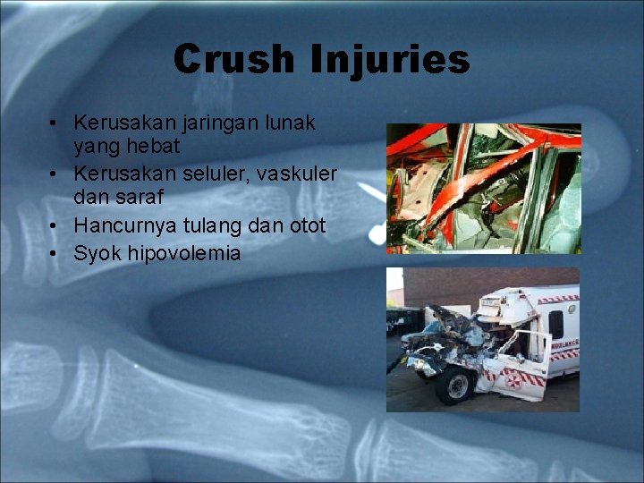 Crush Injuries • Kerusakan jaringan lunak yang hebat • Kerusakan seluler, vaskuler dan saraf Crush Injuries • Kerusakan jaringan lunak yang hebat • Kerusakan seluler, vaskuler dan saraf