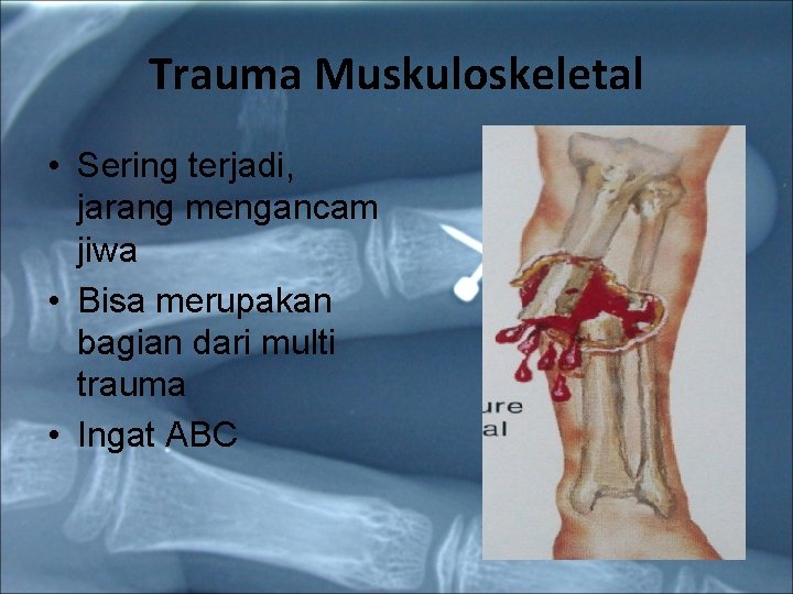 Trauma Muskuloskeletal • Sering terjadi, jarang mengancam jiwa • Bisa merupakan bagian dari multi Trauma Muskuloskeletal • Sering terjadi, jarang mengancam jiwa • Bisa merupakan bagian dari multi