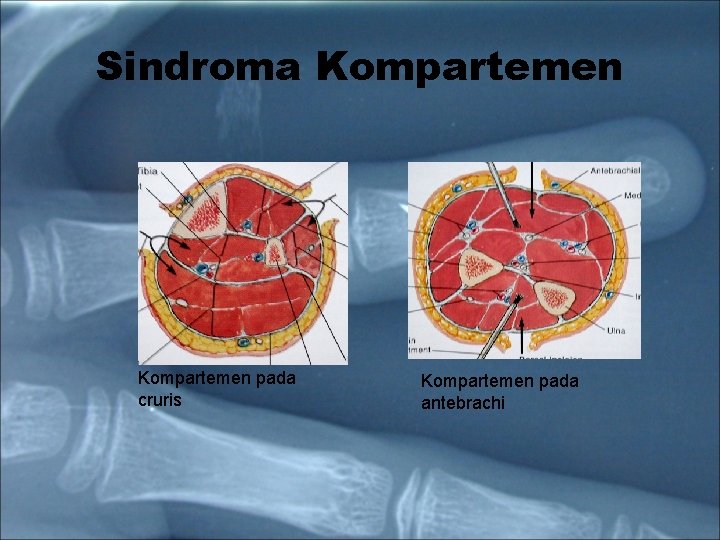 Sindroma Kompartemen pada cruris Kompartemen pada antebrachi 