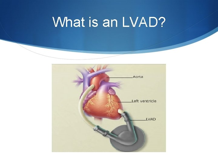 What is an LVAD? 