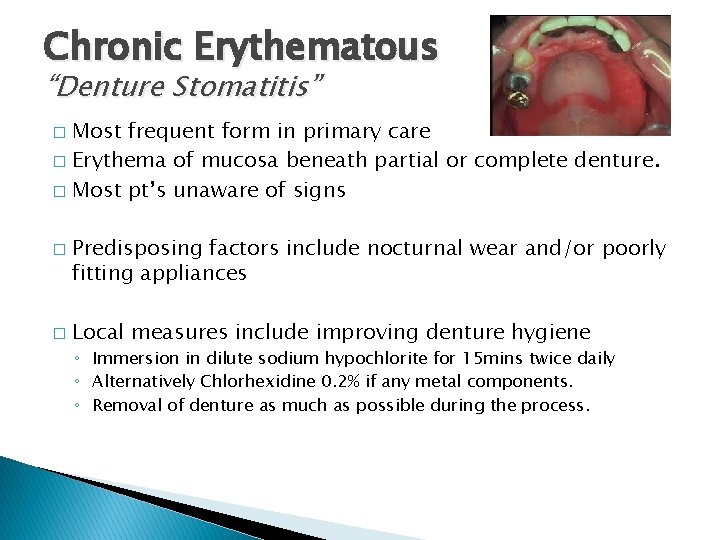 Chronic Erythematous “Denture Stomatitis” Most frequent form in primary care � Erythema of mucosa