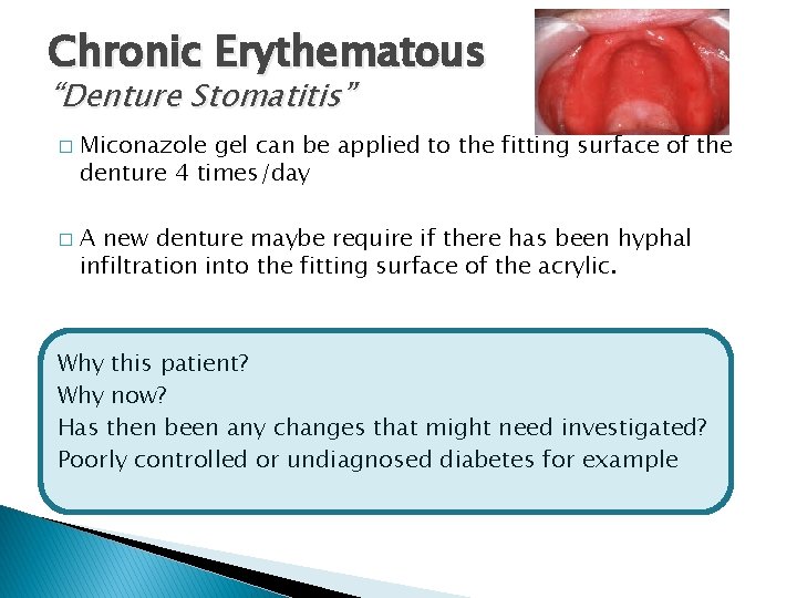 Chronic Erythematous “Denture Stomatitis” � � Miconazole gel can be applied to the fitting