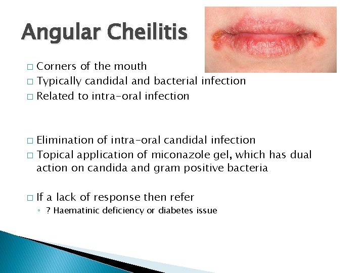 Angular Cheilitis Corners of the mouth � Typically candidal and bacterial infection � Related