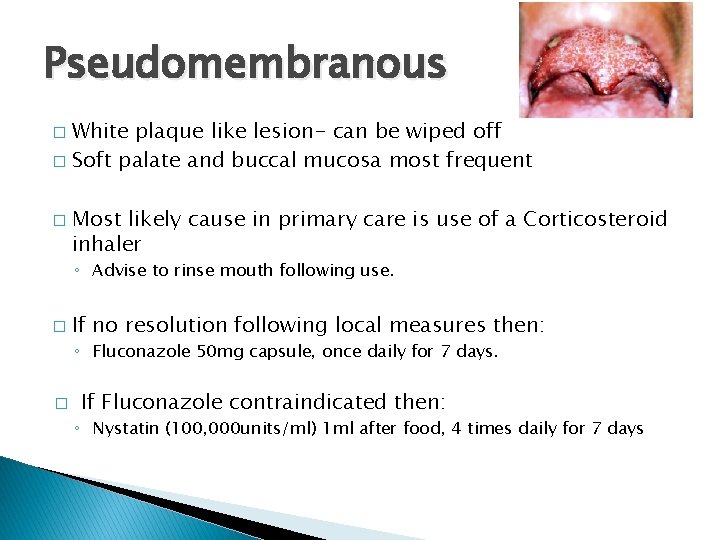 Pseudomembranous White plaque like lesion- can be wiped off � Soft palate and buccal