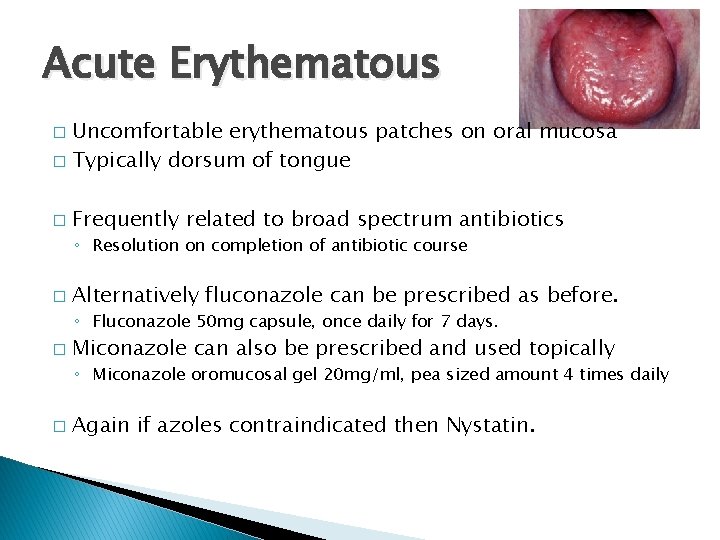 Acute Erythematous Uncomfortable erythematous patches on oral mucosa � Typically dorsum of tongue �
