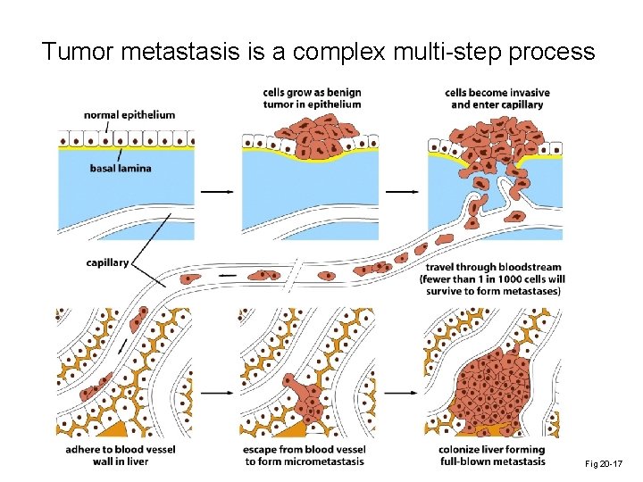 Tumor metastasis is a complex multi-step process Fig 20 -17 