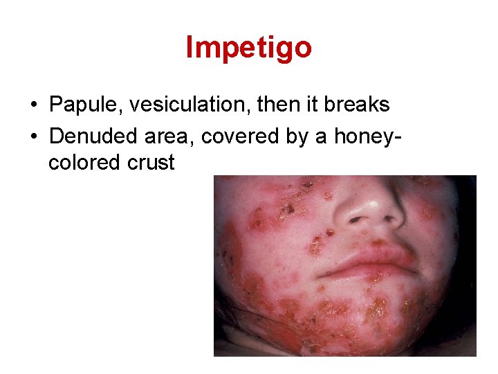 Impetigo • Papule, vesiculation, then it breaks • Denuded area, covered by a honeycolored