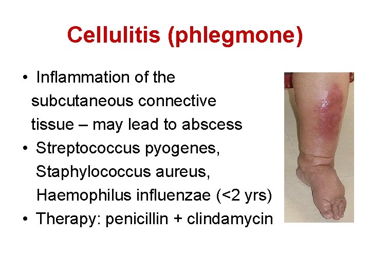 Cellulitis (phlegmone) • Inflammation of the subcutaneous connective tissue – may lead to abscess