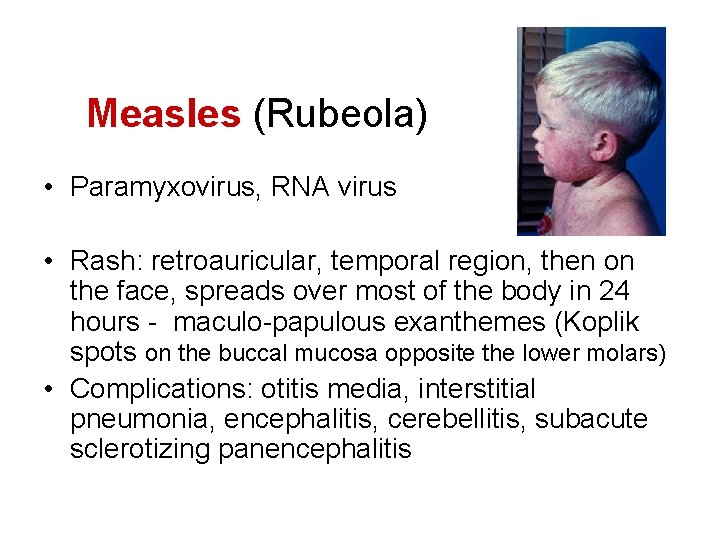 Measles (Rubeola) • Paramyxovirus, RNA virus • Rash: retroauricular, temporal region, then on the