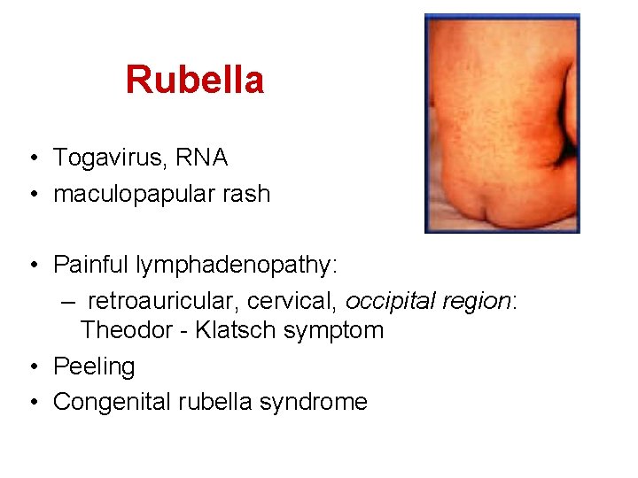 Rubella • Togavirus, RNA • maculopapular rash • Painful lymphadenopathy: – retroauricular, cervical, occipital