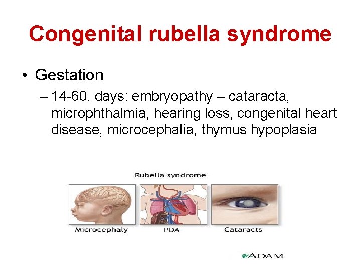 Congenital rubella syndrome • Gestation – 14 -60. days: embryopathy – cataracta, microphthalmia, hearing