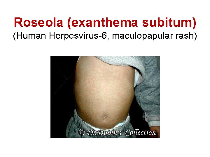 Roseola (exanthema subitum) (Human Herpesvirus-6, maculopapular rash) 