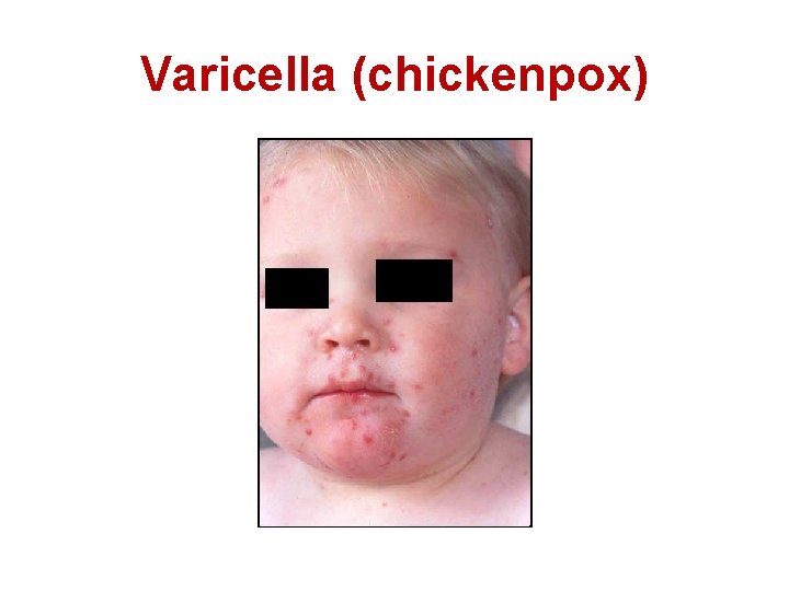 Varicella (chickenpox) 