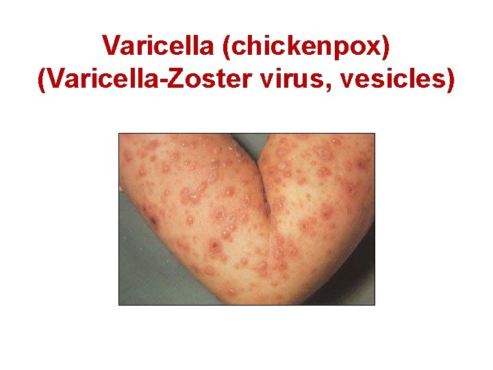 Varicella (chickenpox) (Varicella-Zoster virus, vesicles) 