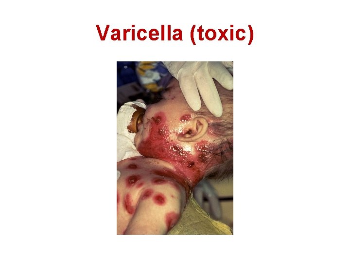 Varicella (toxic) 