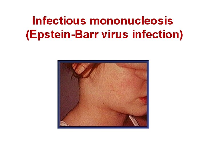 Infectious mononucleosis (Epstein-Barr virus infection) 