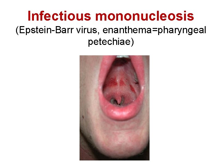 Infectious mononucleosis (Epstein-Barr virus, enanthema=pharyngeal petechiae) 