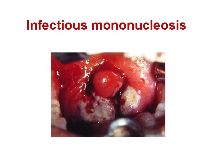 Infectious mononucleosis 