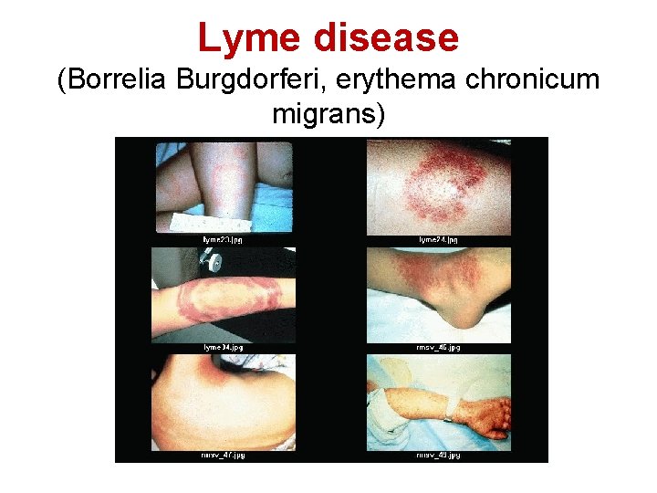 Lyme disease (Borrelia Burgdorferi, erythema chronicum migrans) 