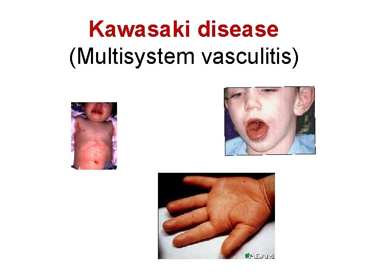 Kawasaki disease (Multisystem vasculitis) 