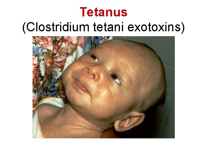 Tetanus (Clostridium tetani exotoxins) 