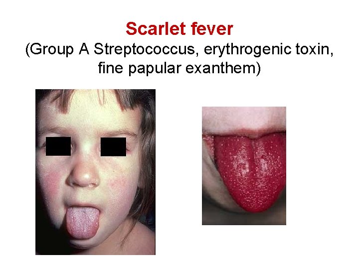 Scarlet fever (Group A Streptococcus, erythrogenic toxin, fine papular exanthem) 