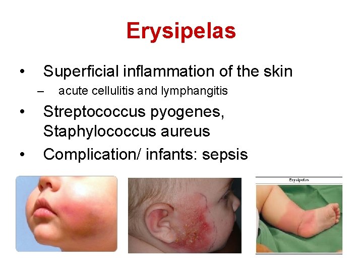 Erysipelas • Superficial inflammation of the skin – • • acute cellulitis and lymphangitis