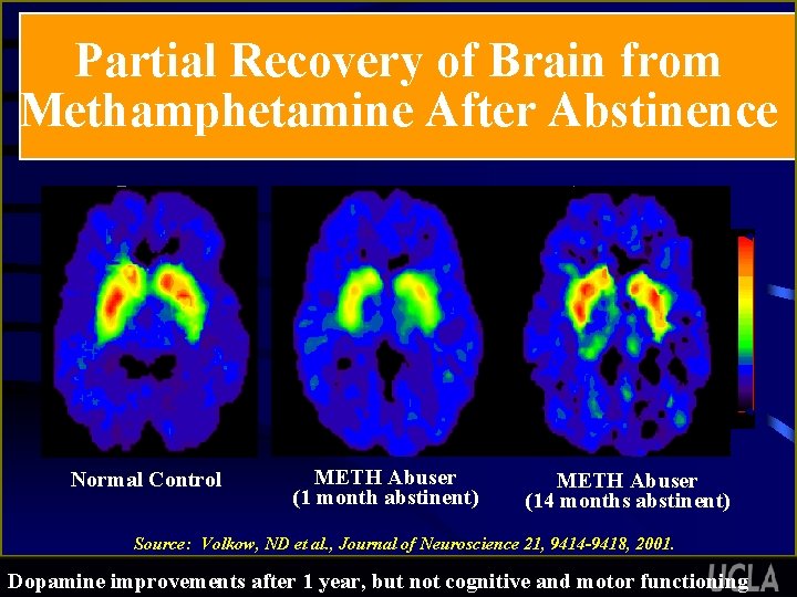 Partial Recovery of Brain from Methamphetamine After Abstinence 3 0 ml/gm Normal Control METH