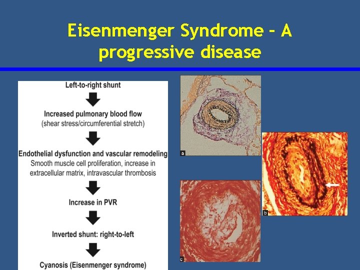 Eisenmenger Syndrome – A progressive disease 