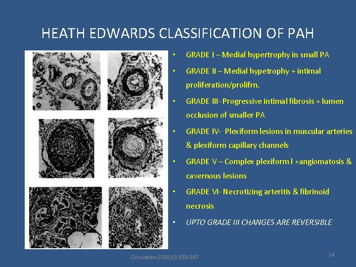HEATH EDWARDS CLASSIFICATION OF PAH • GRADE I – Medial hypertrophy in small PA