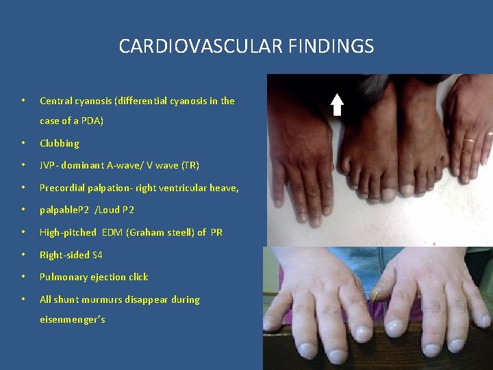 CARDIOVASCULAR FINDINGS • Central cyanosis (differential cyanosis in the case of a PDA) •