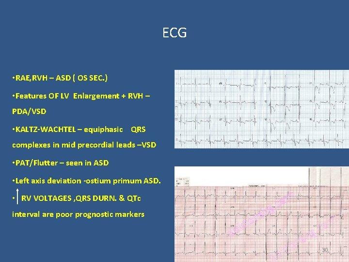 ECG • RAE, RVH – ASD ( OS SEC. ) • Features OF LV