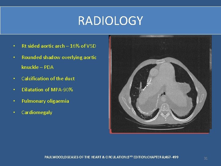 RADIOLOGY • Rt sided aortic arch – 16% of VSD • Rounded shadow overlying