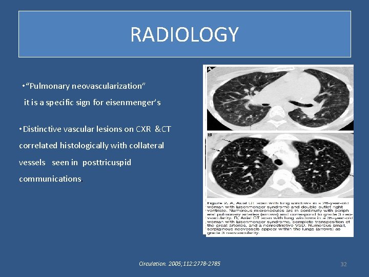 RADIOLOGY • “Pulmonary neovascularization” it is a specific sign for eisenmenger’s • Distinctive vascular