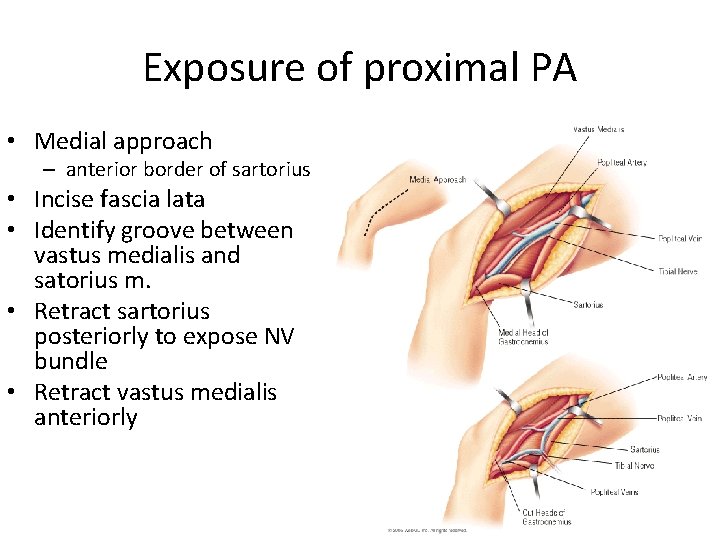 Exposure of proximal PA • Medial approach – anterior border of sartorius • Incise