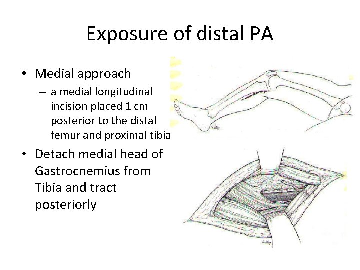 Exposure of distal PA • Medial approach – a medial longitudinal incision placed 1