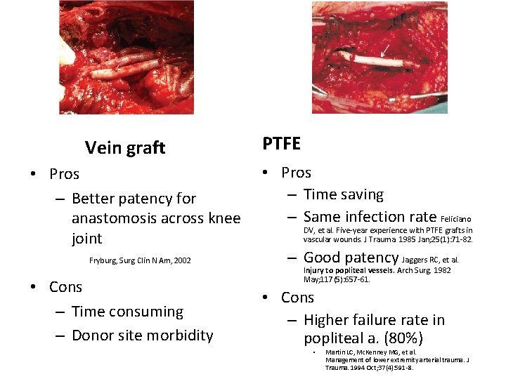 Vein graft • Pros – Better patency for anastomosis across knee joint Fryburg, Surg