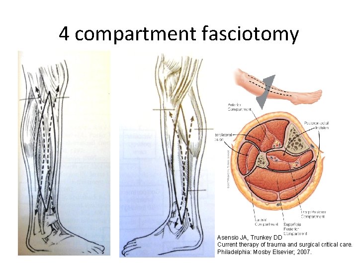 4 compartment fasciotomy Asensio JA, Trunkey DD Current therapy of trauma and surgical critical